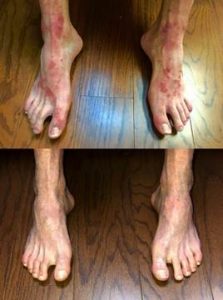 foot psoriasis