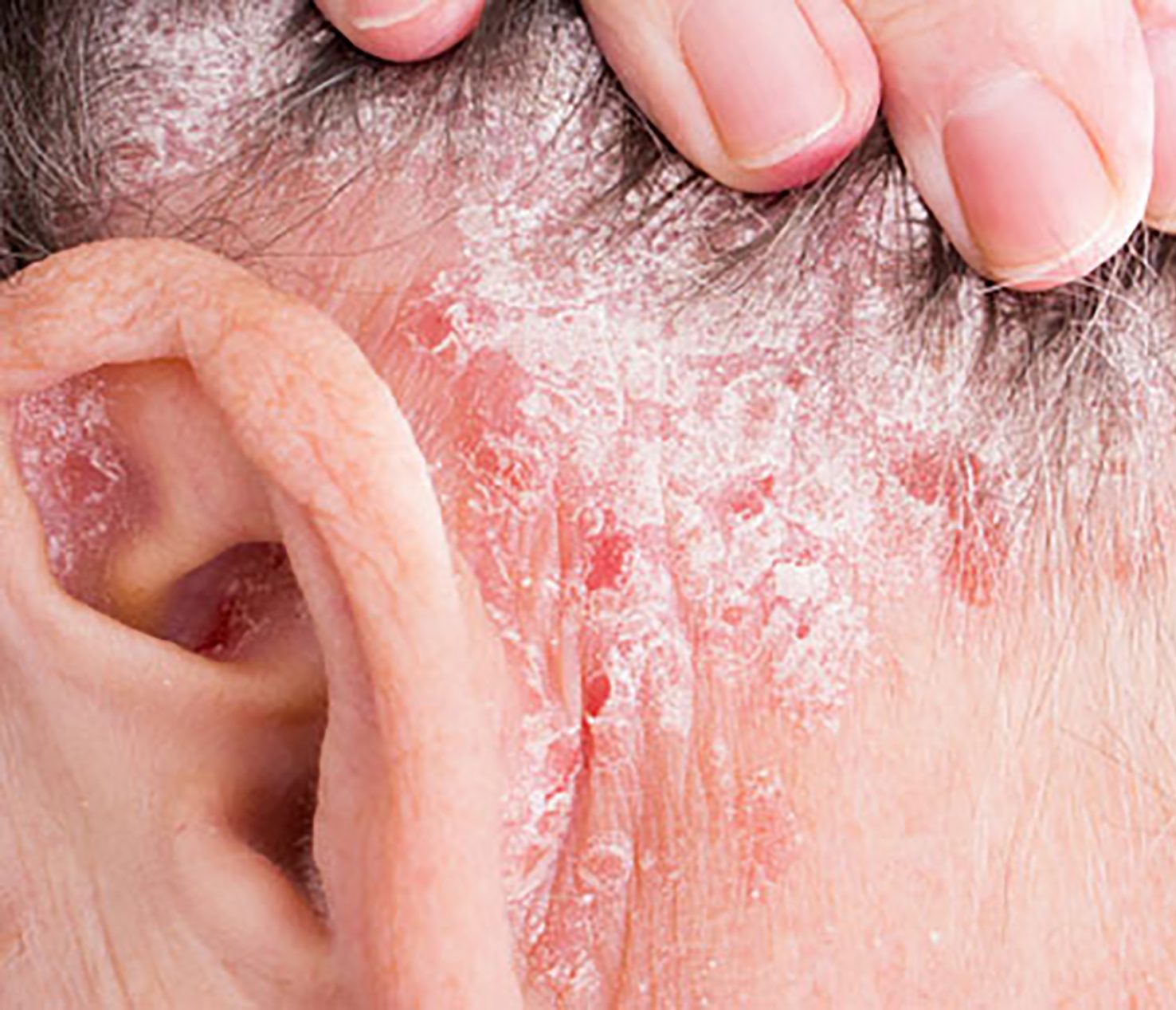 scalp psoriasis