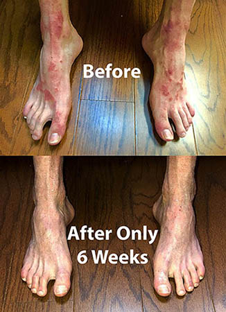 Psorclear is effective treatment for psoriasis