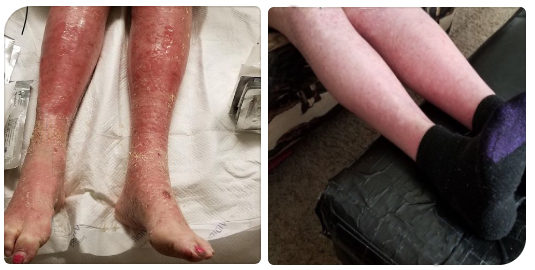 Feet before and after Psorclear treatment