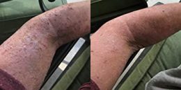 Arm with Psoriasis before and after Psorclear treatment