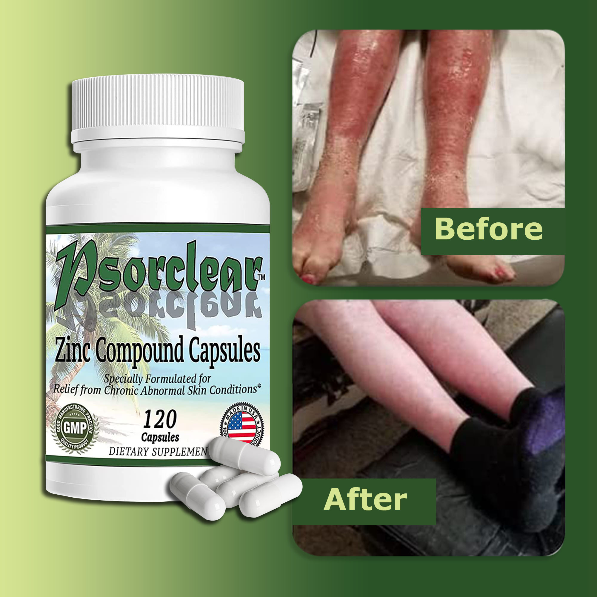 Psorclear Works for Psoriasis and Eczema